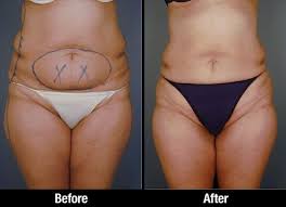 Tumescent Lipo Before After Photos Of Female Patient Liposuction Tumescent Liposuction Lipo Before And After