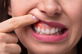 Image result for dental cancer