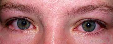 What Are The Side Effects Of Bromine With Pictures