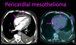 Ct scans of 30 patients were obtained at baseline and after two cycles of . Epos Trade