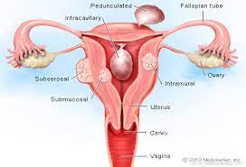 Uterine fibroid tumors, also known as fibroids or leiomyomas, are fairly common, affecting between 20% to 80% of all women. Uterine Fibroids Picture Image On Rxlist Com