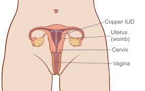 The meaning of iud is: Copper Iud Iud Contraception Melbourne Family Planning Victoria