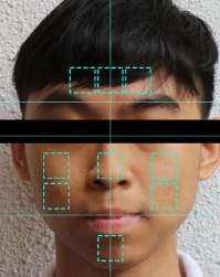Facial Skin Type Analysis Using Few-shot Learning with Prototypical Networks
