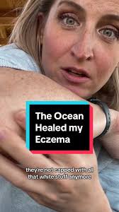The ocean really did heal my eczema 🌊This time of year i would have been  so itchy and miserable #eczema #eczemahealing #theoceanhealedmyeczema  #dryskincare #eczemahealing #tiktokshopspringsale ...