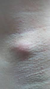 The condition is most prevalent among people who have coarse or curly hair. Painful Red Lump On Armpit Basically Showed Up Over Night What Is It Is It Poppable Popping