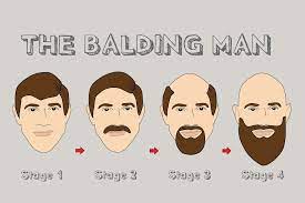 So, concerning males, the x chromosome is by default coming from the mother, while the y chromosome comes certainly from the father. When Will You Go Bald