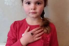 Second girl in hospital after suspected brown recluse spider bite left  oozing black hole in her hand