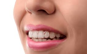 If you don't like the look of traditional braces, ask your orthodontist about clear plastic aligners like invisalign.6 x trustworthy source american although every overbite is different, you should expect to wear braces for a couple of years at least. 5 Steps To A Straight Smile With Invisalign Academy Dental