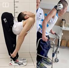 💪 **From Folded to Fearless: The Story of Jiang Yanchen** 🌟 Born with a spine  so twisted he could barely lift his head, **Jiang Yanchen**, known as *“the  folded boy”*, spent **19