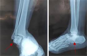 Image result for Subtalar Dislocation
