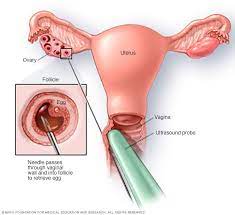 Get the top ivf abbreviation related to medical. In Vitro Fertilization Ivf Mayo Clinic