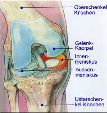 Diese verletzung ist folge einer starken krafteinwirkung, die den meniskus von innen beschädigt; Kniegelenk Ou Gmund