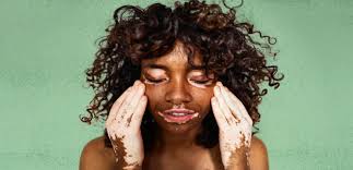 Image result for Vitiligo