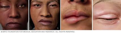 Image result for Angioedema