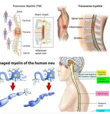 Image result for Myelitis