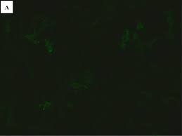 Transverse myelitis anu jacob, m.d.,1 and brian g. Aquaporin 4 Antibody Positive Short Transverse Myelitis Associated With Breast Cancer Multiple Sclerosis And Related Disorders