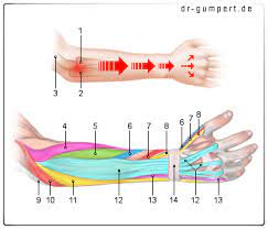 Symptome Eines Tennisarms