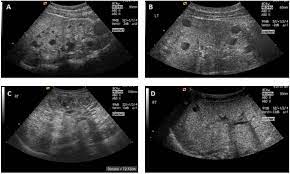 Frontiers Genetics Of Autosomal Recessive Polycystic Kidney Disease And Its Differential Diagnoses Pediatrics