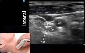 Image result for Superior Trunk Block