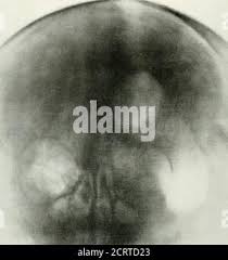 Image result for Nuclear Ventriculogram