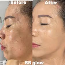 Glow laser & beauty • med spa. Envie Laser Health And Beauty Center Bb Glow Brightcolours Brighterskin Tighten Facebook