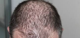Wechseljahre einnahme der pille schwangerschaft &stillzeit geheimratsecken bei der frau? Haarausfall Friseur Com