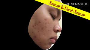 Cara paling ampuh dan cepat menghilangkan mata panda hitam secara alami dan hasil permanen. Cara Hilangkan Kesan Parut Jerawat Dengan Cepat Youtube Jerawat