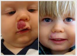 Normally people do not take it seriously to need treatment but due to cosmetic purposes, some people desire the removal of the angiomas or moles. New York Hemangiomas Before And After Photos Los Angeles