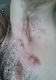 hidradenitis suppurativa hs nedir belirtileri nelerdir bitkisel tedavisi