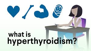 Image result for Hyperthyroidism