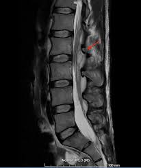 Image result for Spinal Epidural Abscess