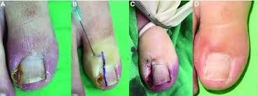 Image result for Paronychia feet