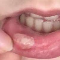 Eine schwellung der lippe nach der unterspritzung ist völlig normal und kann bis 14 tage dauern bis es abschwillt.bitte bewahren sie eine schwellung nach einer lippen aufspritzung mit hs ist normal. Nach Biss Auf Lippe Weisses Etwas Gesundheit Weiss