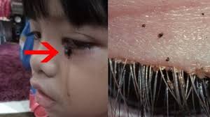 Sengkenit atau kutu babi adalah bintang parasit yang biasa ditemui di persekitaran kita. Anak Kesayangan Hobi Main Kucing Ibu Ini Tak Menyangka Kutu Babi Menggerogoti Mata Si Buah Hati Tribunnews Com Mobile