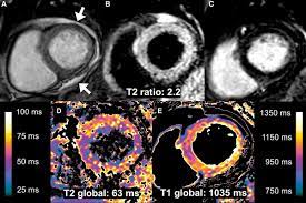 Case contributed by dr hidayatullah hamidi. Diffuse Myocardial Inflammation In Covid 19 Associated Myocarditis Detected By Multiparametric Cardiac Magnetic Resonance Imaging Circulation Cardiovascular Imaging