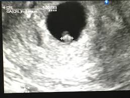 Get a free return if your baby is not cooperating. Anyone Had A Scan At 6 Weeks Mumsnet