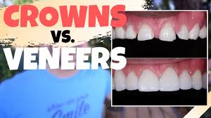 Maybe you would like to learn more about one of these? Dental Crowns Vs Porcelain Veneers Is The Dental Veneers Procedure Worth It Youtube