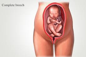Image result for Breech Delivery