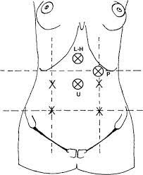 The universally preferred point of entry in previous surgery cases is the palmer's point developed by palmer. Principles Of Safe Abdominal Entry In Laparoscopic Gynecologic Surgery Sciencedirect