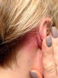 What Is A Patch Test And Why Do I Need To Have One The Hideout Coventry