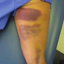 If you strain your hamstring while sprinting in full stride, you will notice a sudden, sharp pain in the back of your thigh. Pdf Evaluation And Management Of Hamstring Injuries