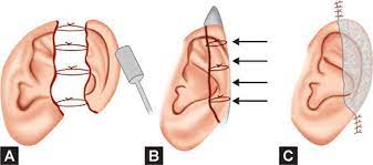 A two staged modified mladick approach was used to reimplant the amputated ear … Jaypeedigital Ebook Reader