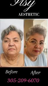 ✨ Fotona EndoTight ✨, A refined, precision-based internal laser treatment  designed to rejuvenate and restore. Fotona EndoTight works deep within to  stimulate collagen, improve tightness, and enhance ...