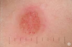 Image result for Spitz Nevus