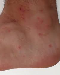 What causes itchy bumps on skin? 11 Common Bug Bite Pictures How To Id Insect Bites And Stings