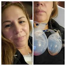 Hi ladies. Thx God my surgery went out very well. I explanted 2 days ago  with Dr. Dev Vihakar. He is an excellent doctor, very kind and  professional. Also, his anesthesiologist George