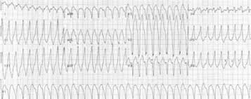 Right Ventricular Outflow Tract Tachycardia Stanford Health Care