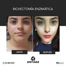 Bichectomia Guadalajara Publicaciones Facebook