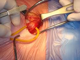 It is in the rub area where i contact the seat. Inguinal Hernia Surgery Wikipedia