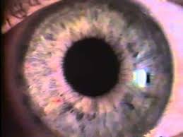 Image result for Pupillary Paralysis